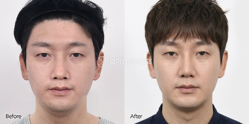 261001_Rhinoplasty_1