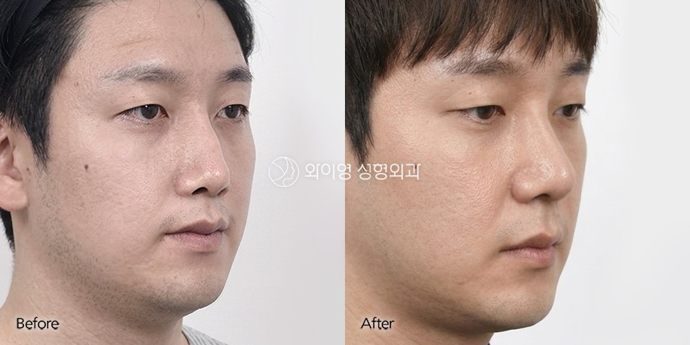 261001_Rhinoplasty_2