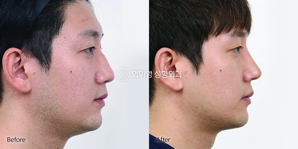 261001_Rhinoplasty_3