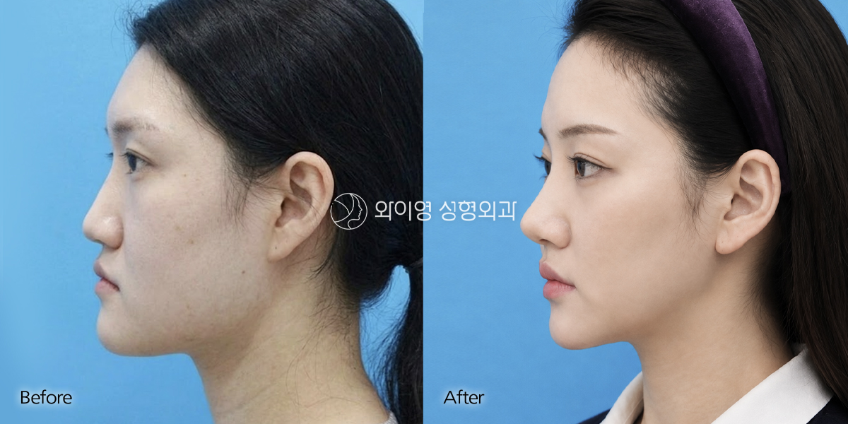 facialcontouring
rinnoplasty
