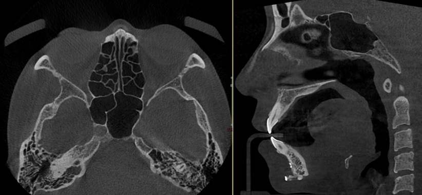 Axial and lateral CT views demonstrating anatomical fit of a 3D customized silicone implant after rhinoplasty