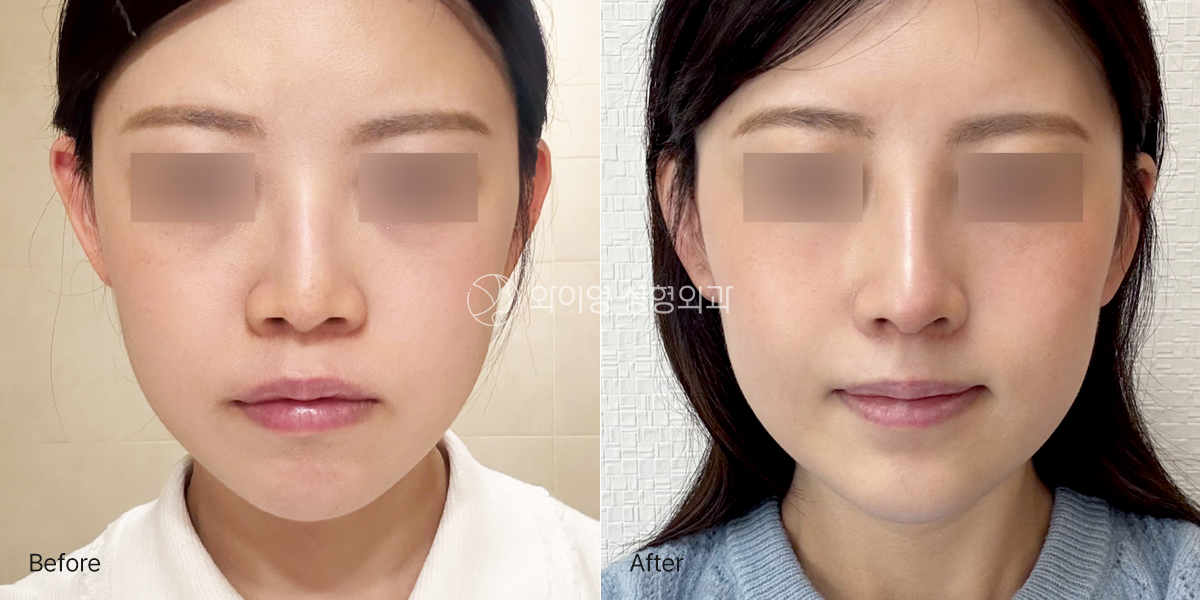 BeforeAfter_front-kr_out