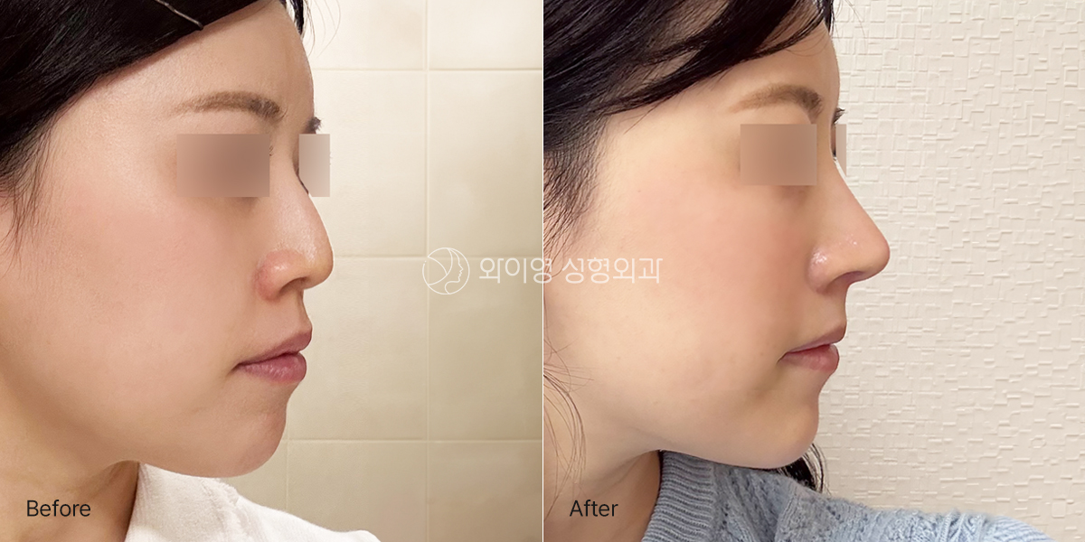 BeforeAfter_side-kr_out