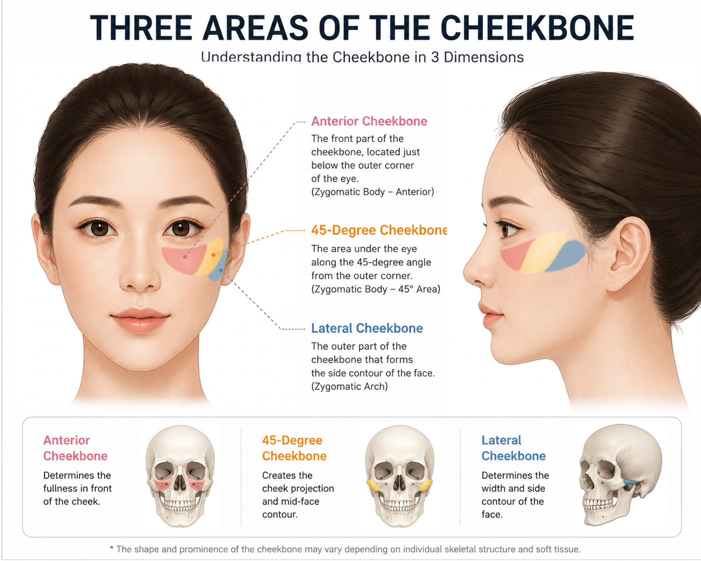 An anatomical illustration dividing the cheekbone into three regions: the anterior cheekbone, the 45-degree cheekbone (malar eminence), and the lateral zygomatic arch.