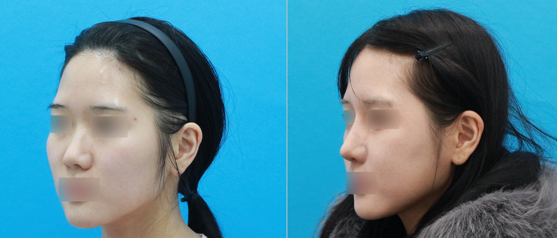 Before-and-after 45-degree facial photographs showing improved facial balance and a slimmer facial contour following facial contouring surgery.