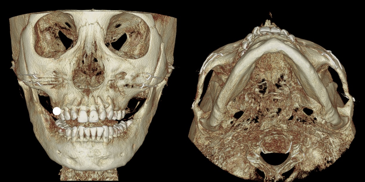 Three-dimensional CT images showing inward movement of the lateral zygomatic arch while residual prominence of the 45-degree cheekbone remains.