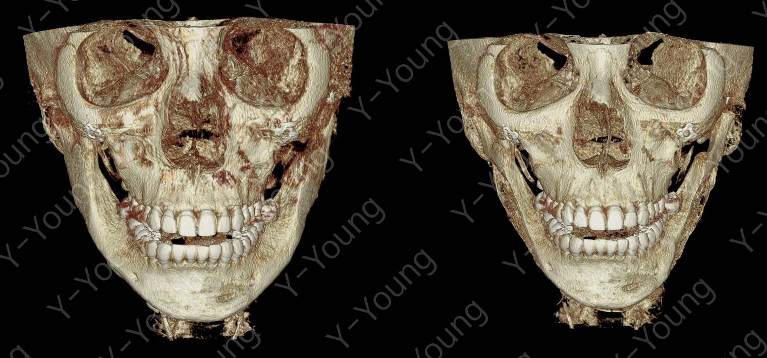 3D CT before and after mandibular cortical bone reduction in a patient who could not undergo further jaw angle reduction.