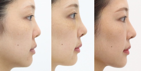 Upturned nose after rhinoplasty – side view before surgery, at 1 week, and 6 months after surgery