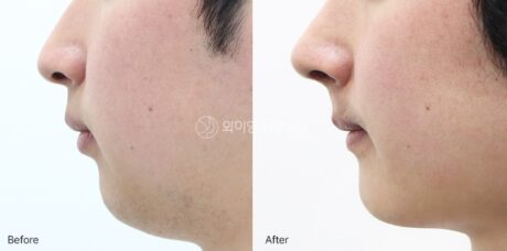 Chin Advancement Surgery: Small Change, Major Difference