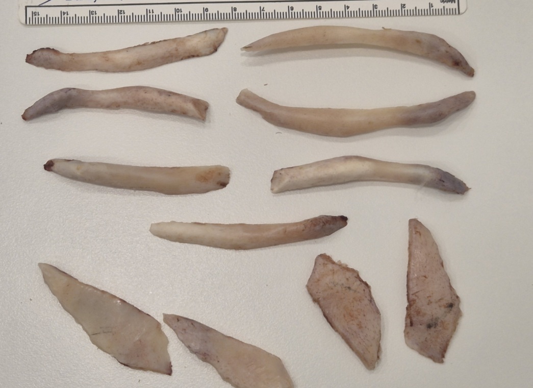 Mandibular angle resection and cortical bone reduction specimens from facial contouring surgery demonstrating balanced contour refinement