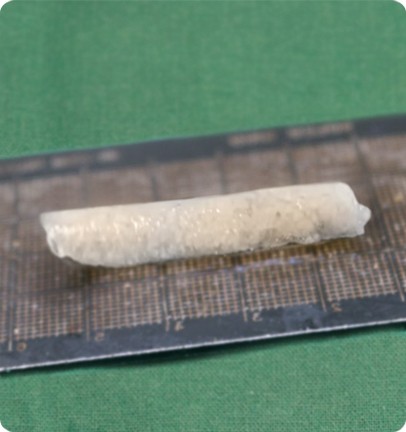 Figure 2. Diced rib cartilage graft prepared for nasal bridge augmentation.