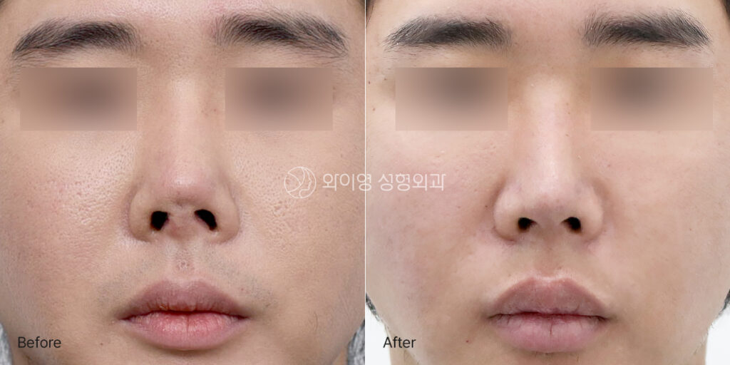 Before and after contracted nose revision surgery showing improved nasal length, tip projection, and overall nasal symmetry
