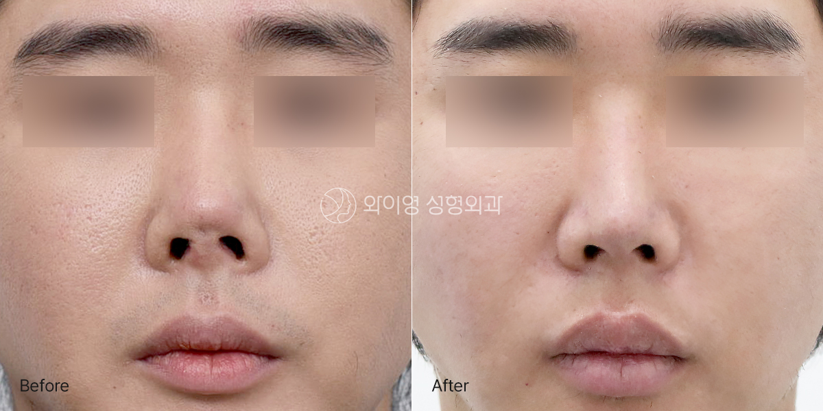 Before and after contracted nose revision surgery showing improved nasal length, tip projection, and overall nasal symmetry