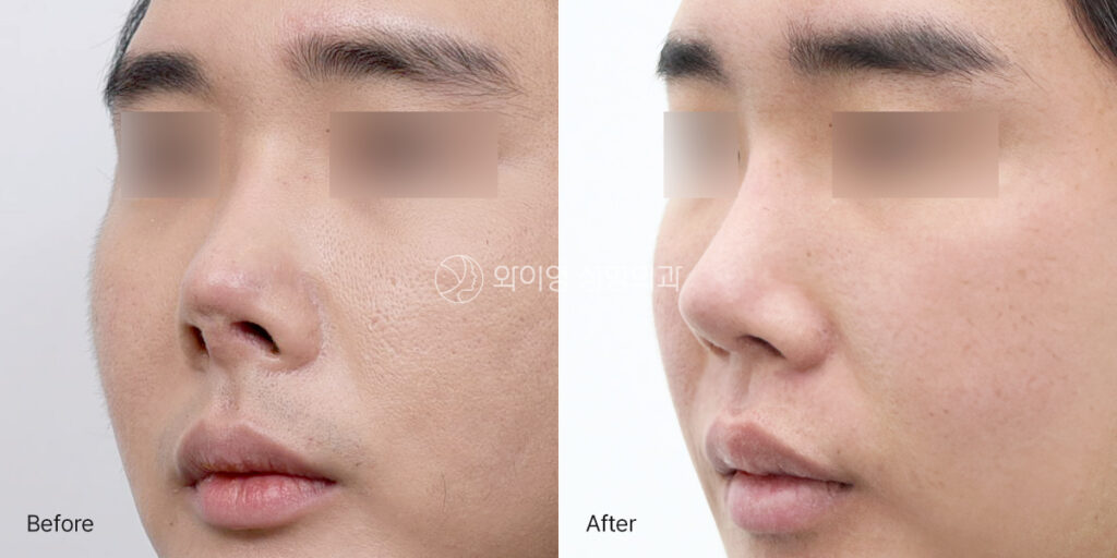 Oblique before and after view of contracted nose revision surgery at 1 month showing improved nasal length, tip projection, and structural support