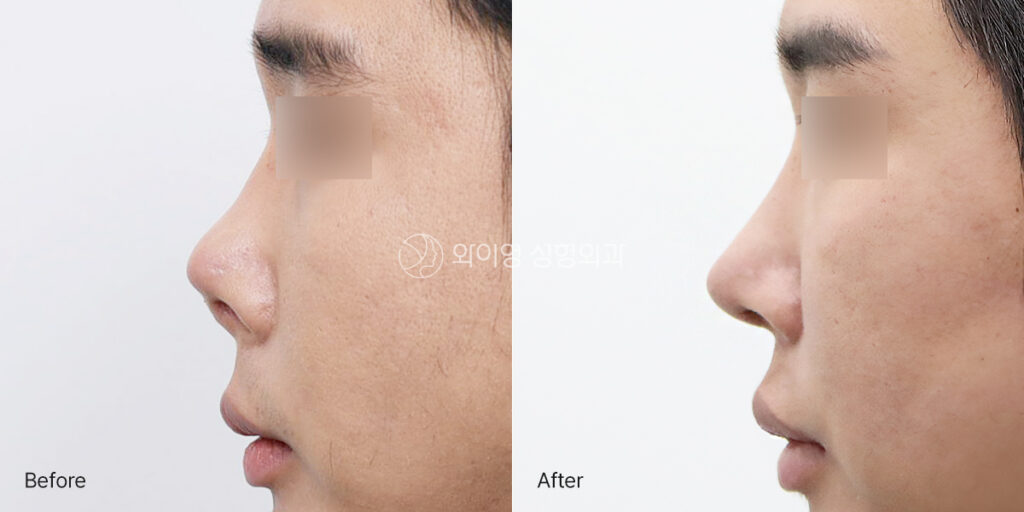Side view before and after contracted nose revision surgery at 1 month showing improved nasal length, tip projection, and a smoother nasal profile
