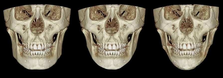 3D CT comparison of mandibular contour before and after cortical bone reduction surgery