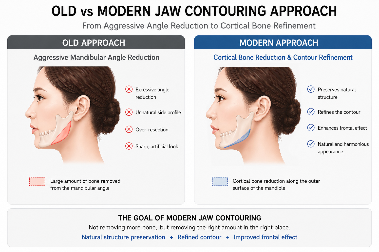 Illustration comparing traditional aggressive mandibular angle reduction and modern cortical bone reduction techniques in jaw contouring surgery