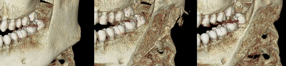 Sequential postoperative CT scans showing stable mandibular contour after cortical bone reduction