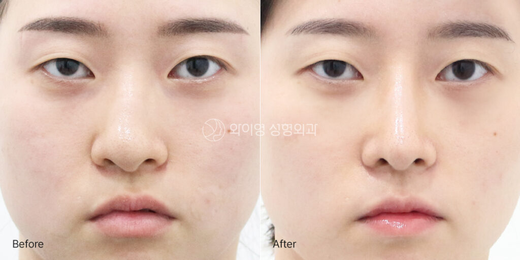 Before and 2 months after crooked nose and hump nose rhinoplasty using autologous rib cartilage, showing a straighter nasal bridge and improved facial symmetry.