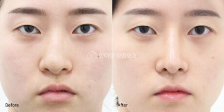 Why Is My Nose Still Crooked After Revision Rhinoplasty?
