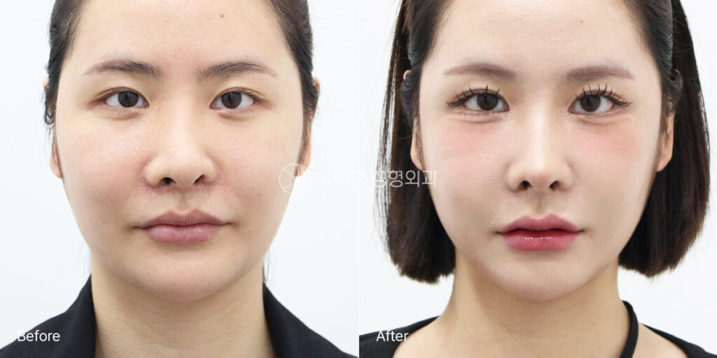 Crooked nose and low nasal tip corrected after revision rhinoplasty, 1 month postoperative front view