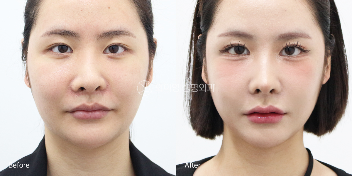 Crooked nose and low nasal tip corrected after revision rhinoplasty, 1 month postoperative front view