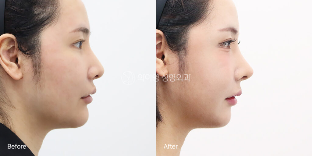 Side view before and after revision rhinoplasty for a crooked nose and low nasal tip in Korea