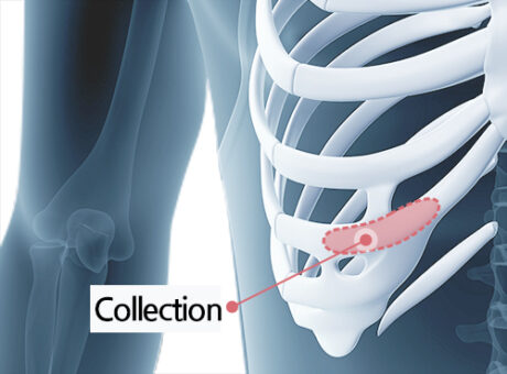 Septal Cartilage, Donor Rib, or Your Own Rib: How Do We Choose for Rhinoplasty?