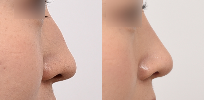 Female hump nose before and after no-implant rhinoplasty in Korea without silicone