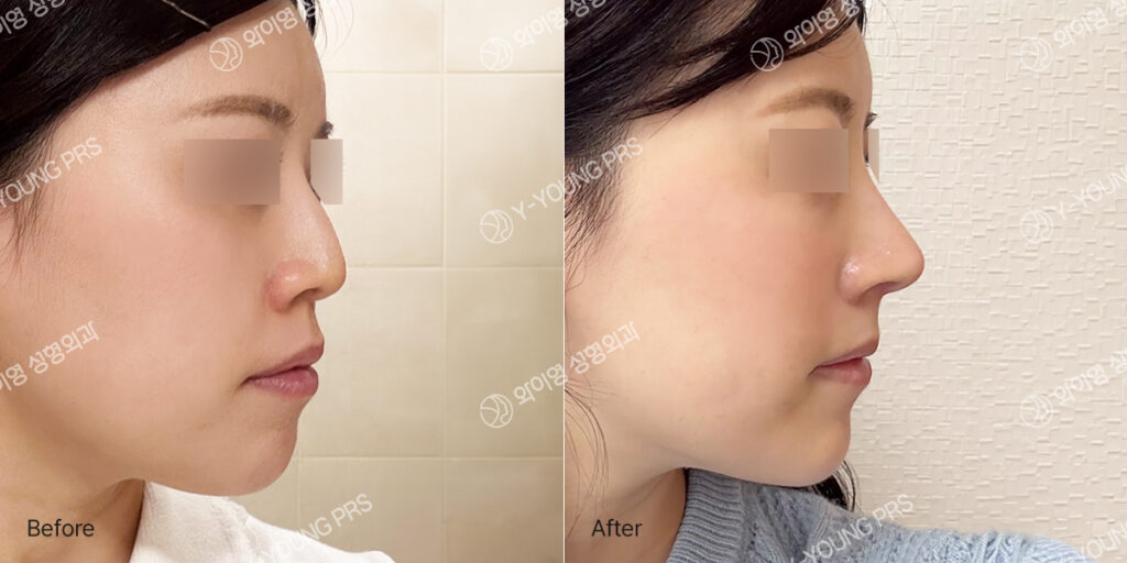 Female before and after no-implant rhinoplasty following removal of absorbable nasal threads