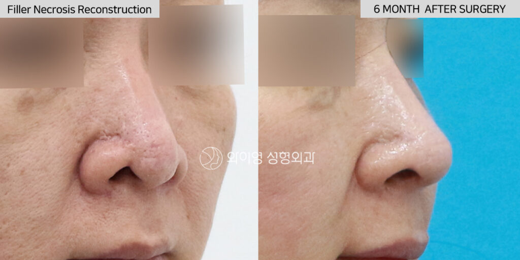 45-degree before and after filler necrosis reconstruction using autologous rib cartilage revision rhinoplasty in Gangnam, Seoul, Korea
