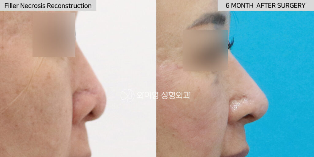 Lateral before and after filler necrosis reconstruction using autologous rib cartilage revision rhinoplasty in Gangnam, Seoul, Korea