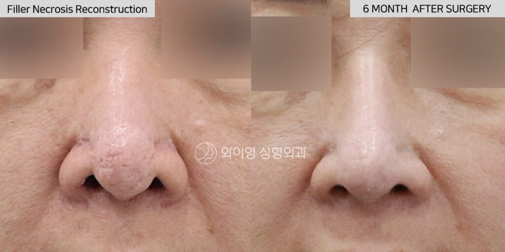 Before and after filler necrosis reconstruction with autologous rib cartilage revision rhinoplasty in Gangnam, Seoul, Korea