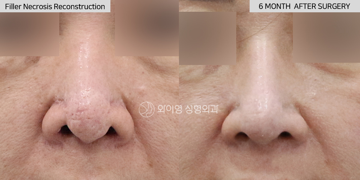 Before and after filler necrosis reconstruction with autologous rib cartilage revision rhinoplasty in Gangnam, Seoul, Korea