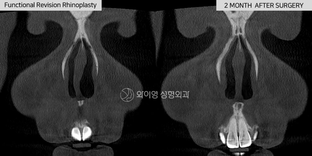 CT before and after functional revision rhinoplasty with deviated septum correction in Korea restoring nasal breathing and structural support