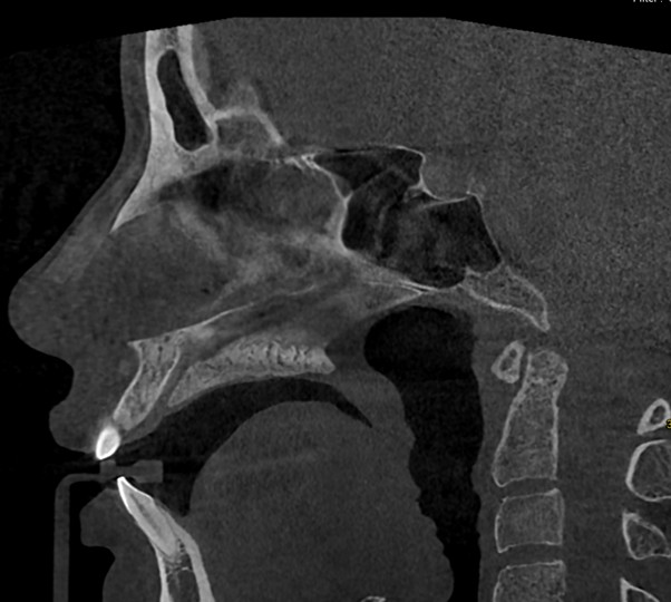 6-month postoperative CT scan showing customized dorsal hump implant positioning