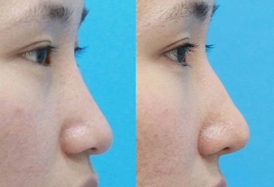 Preoperative and 6-month postoperative side profile after customized hump creation rhinoplasty