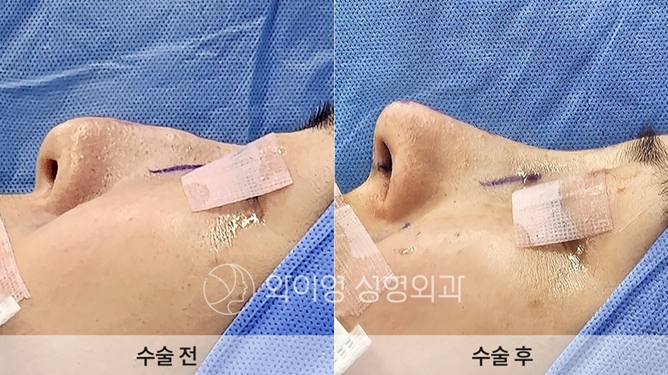Hump nose rhinoplasty before and after side profile comparison showing natural dorsal hump refinement and balanced nasal contour