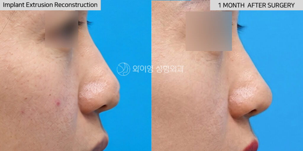 Before and after implant extrusion reconstruction using autologous rib cartilage revision rhinoplasty in Gangnam, Seoul, Korea after silicone implant extrusion through the nasal tip