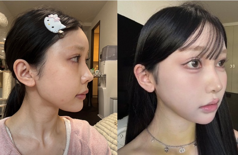 Before and 1-week-after revision jaw contour surgery showing smoother jawline and softer lower facial contour