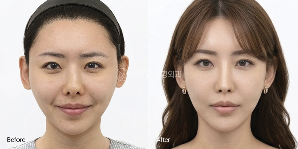 Before and after low bridge nose rhinoplasty showing improved nasal bridge height, tip definition, and overall facial balance