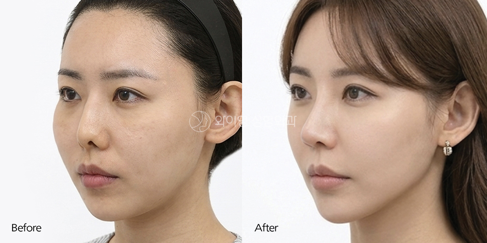 Oblique before and after low bridge nose rhinoplasty showing enhanced nasal bridge height, refined tip definition, and improved facial balance