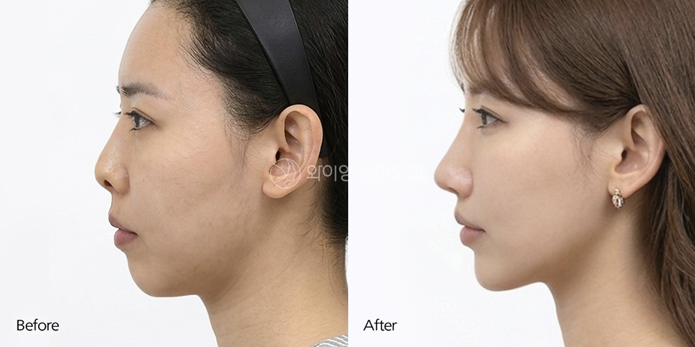 Side view before and after low bridge nose rhinoplasty showing enhanced nasal bridge height, refined tip projection, and a balanced facial profile