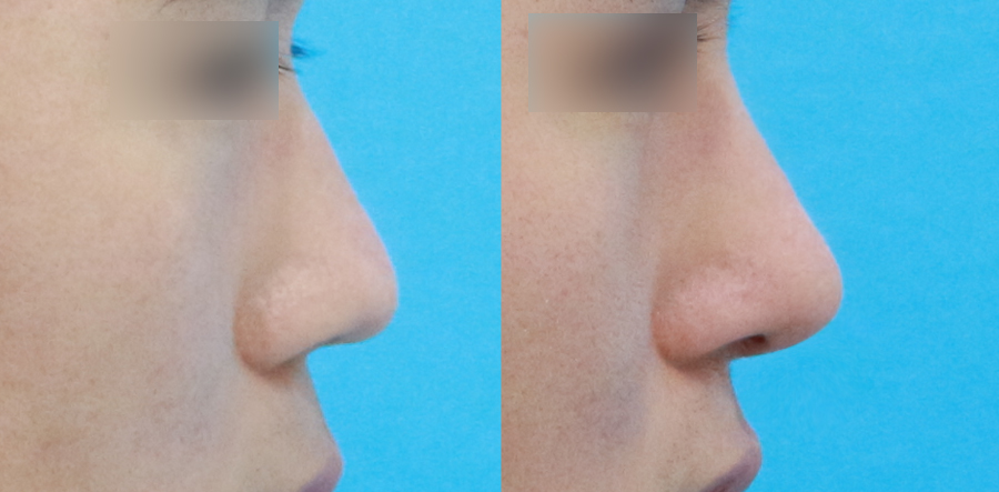 Male low nose before and after no-implant rhinoplasty in Korea without silicone