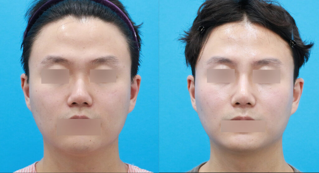 Male no-implant rhinoplasty with autologous rib cartilage, before and 3 months after surgery, front view
