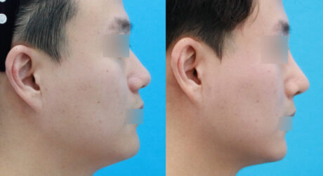Can a Very Low Asia Nose Be Raised Without Silicone? A No-Implant Rhinoplasty Case