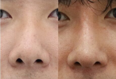 How Long Does Rhinoplasty Swelling Last? A Week-by-Week Recovery Guide