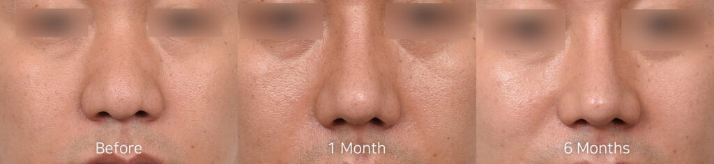 Male thick skin bulbous nose rhinoplasty before surgery, 1 month and 6 months after surgery