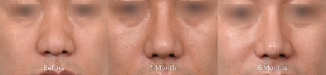 Thick Skin Rhinoplasty: Why Tip Definition Takes Longer