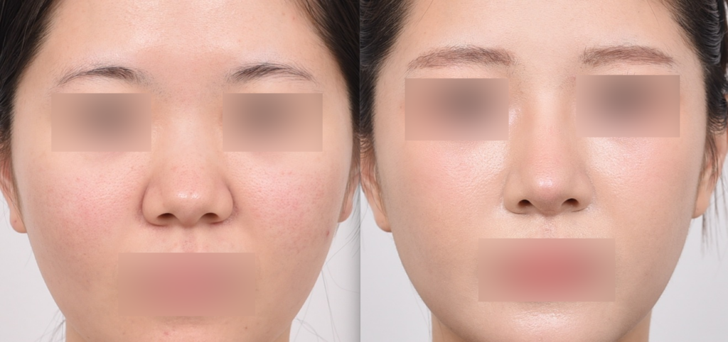 Before and after no-implant rhinoplasty for thick skin and a bulbous nose – front view